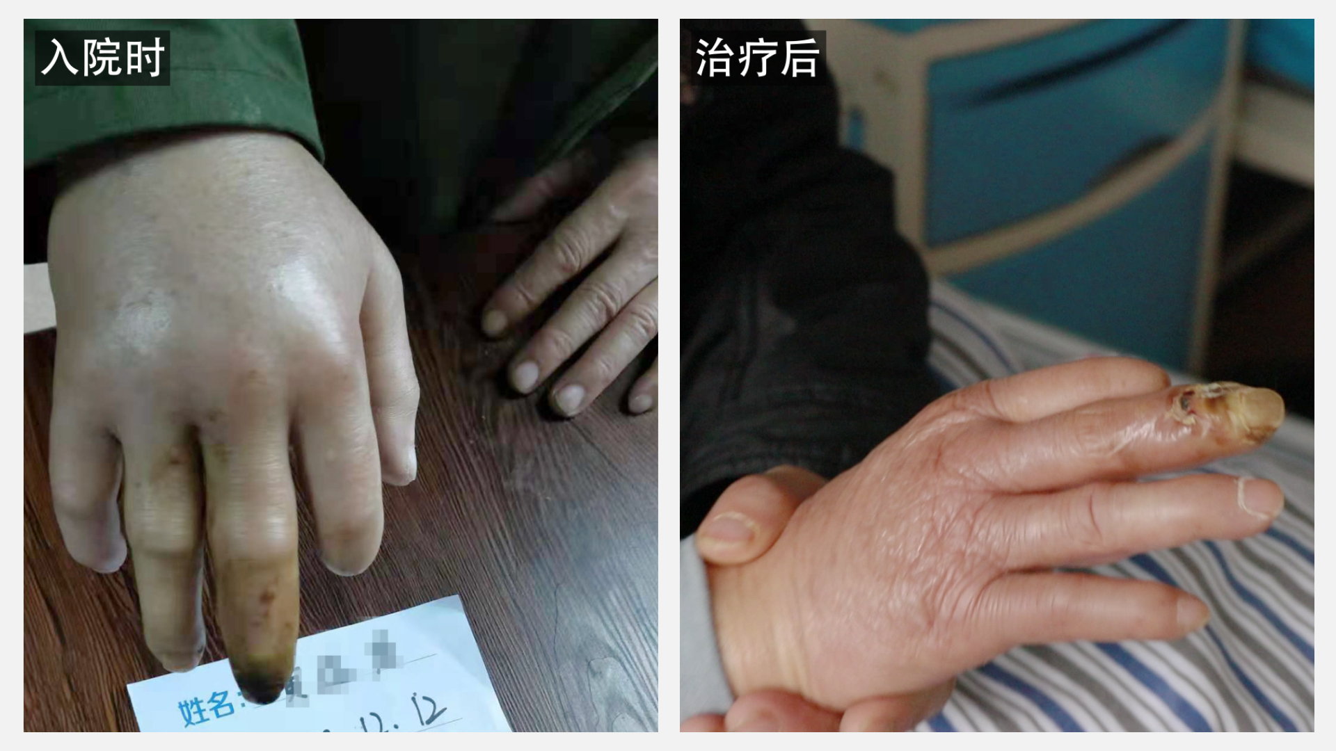 血栓闭塞性脉管炎,成都川蜀血管病医院