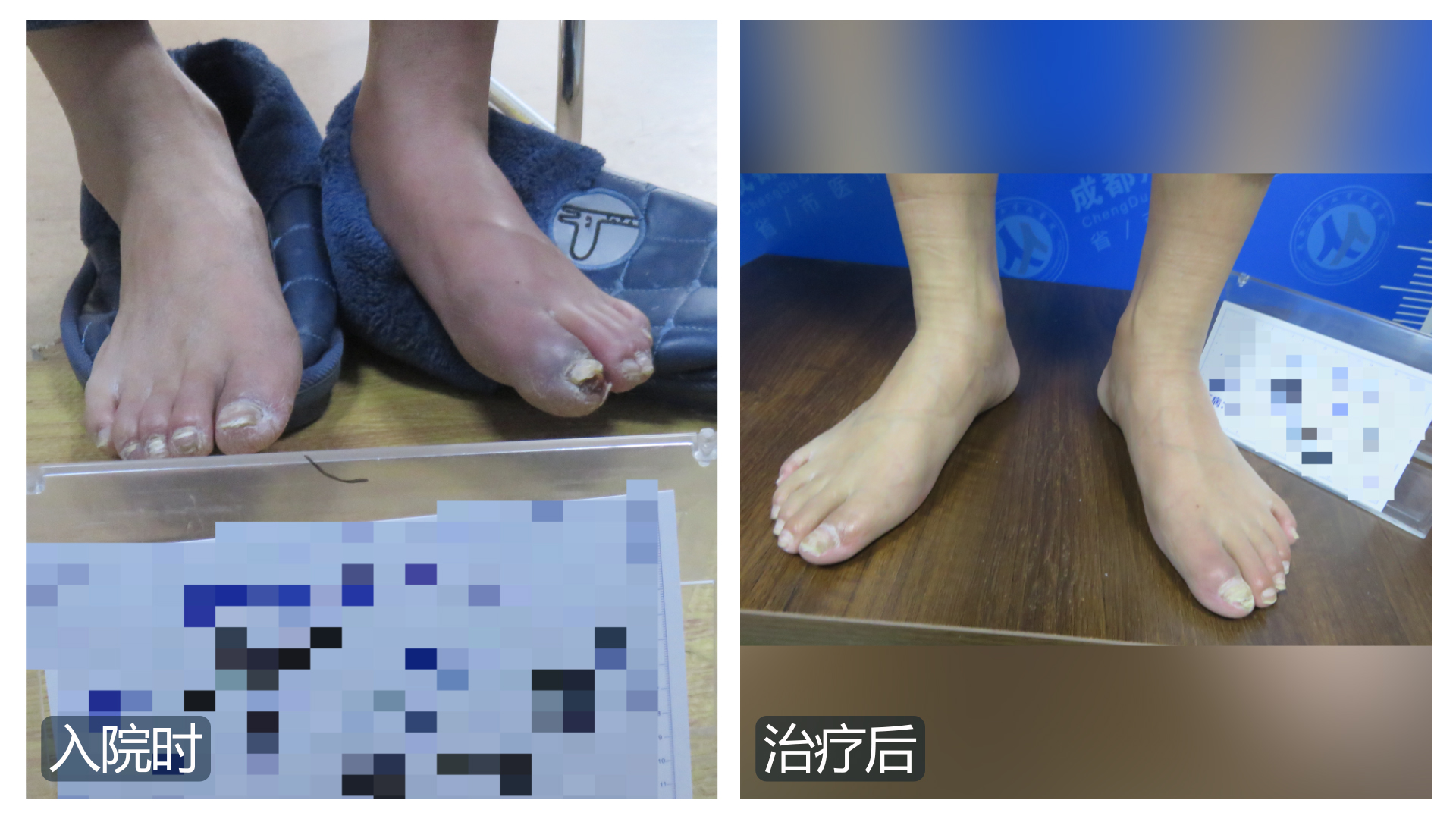 成都治疗血栓闭塞性脉管炎,成都川蜀血管病医院