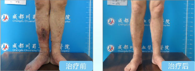 成都治疗老烂腿,老烂腿怎么治疗,成都川蜀血管病院