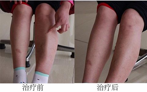 静脉血栓危害,静脉血栓病因,成都川蜀血管病医院