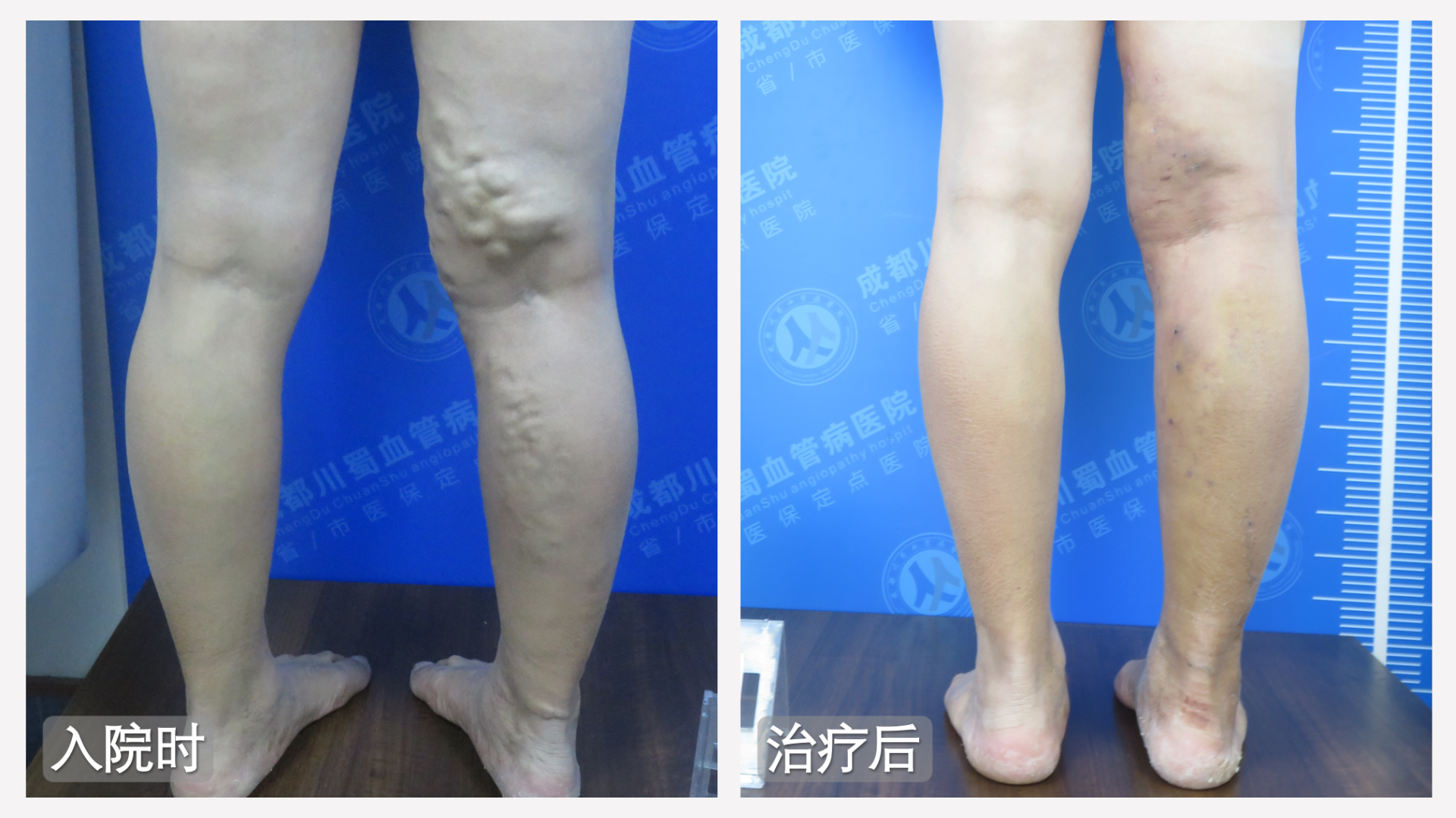 老烂腿预防,老烂腿,成都川蜀血管病医院