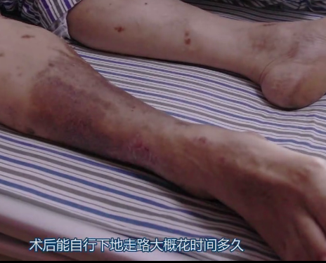 皮肤血管炎症状,成都川蜀血管病医院